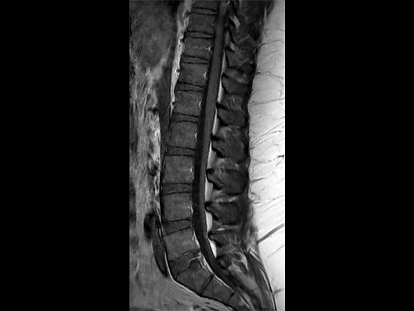 Sagittal T1w TSE post-gado