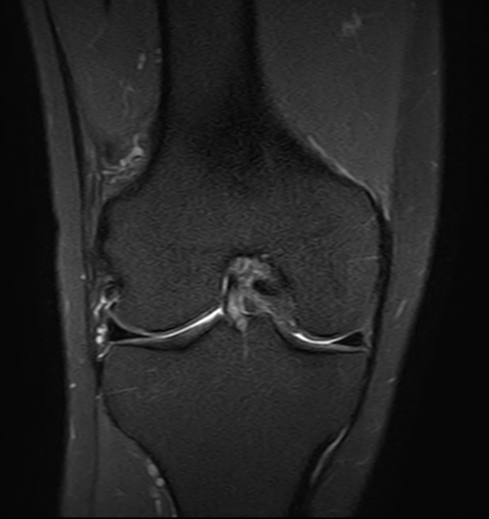Coronal PDw TSE FatSat
