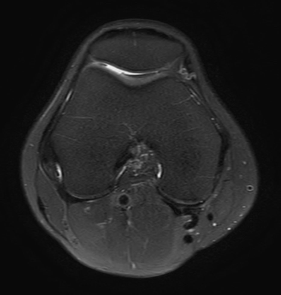 Axial PDw TSE FatSat