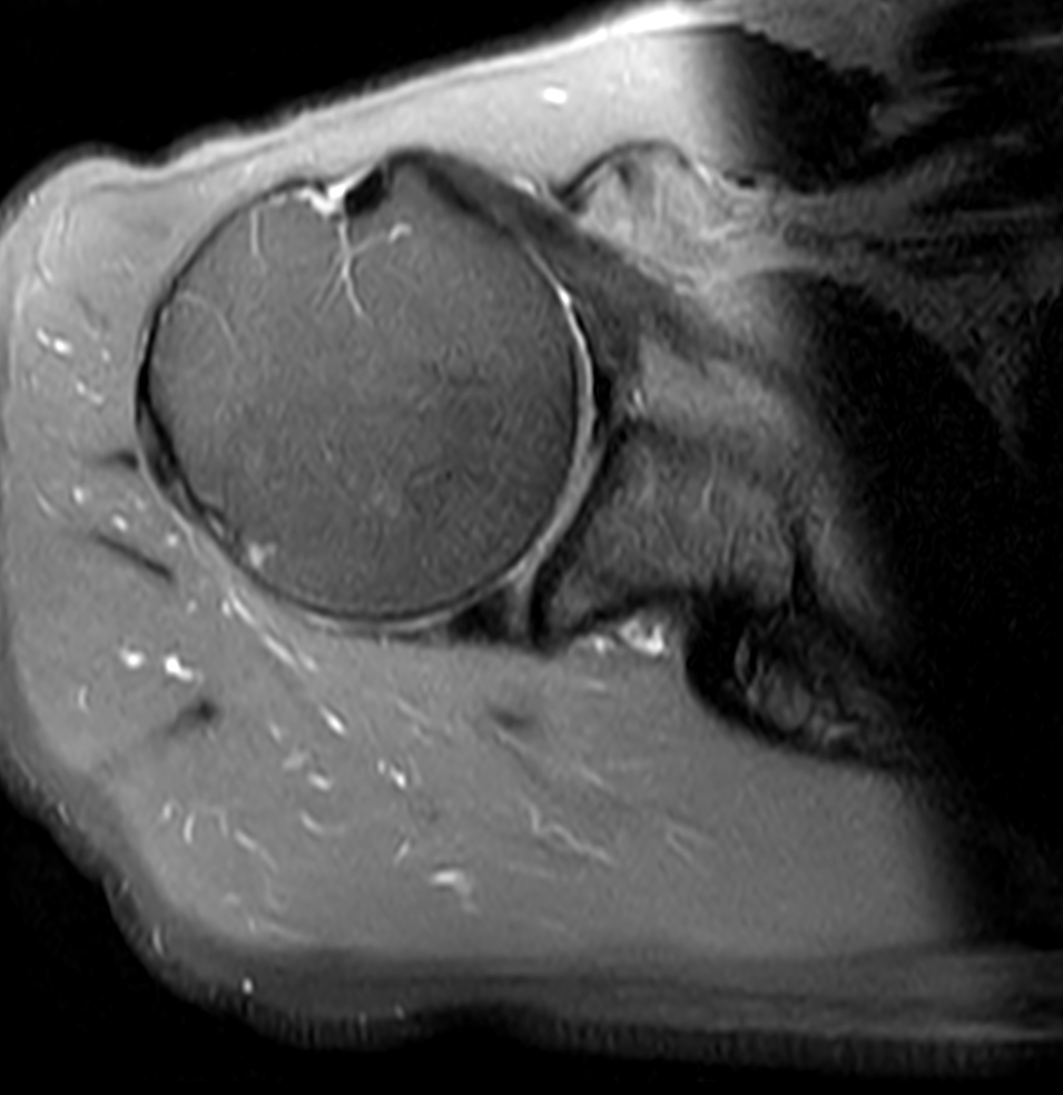 Axial PDw TSE FatSat