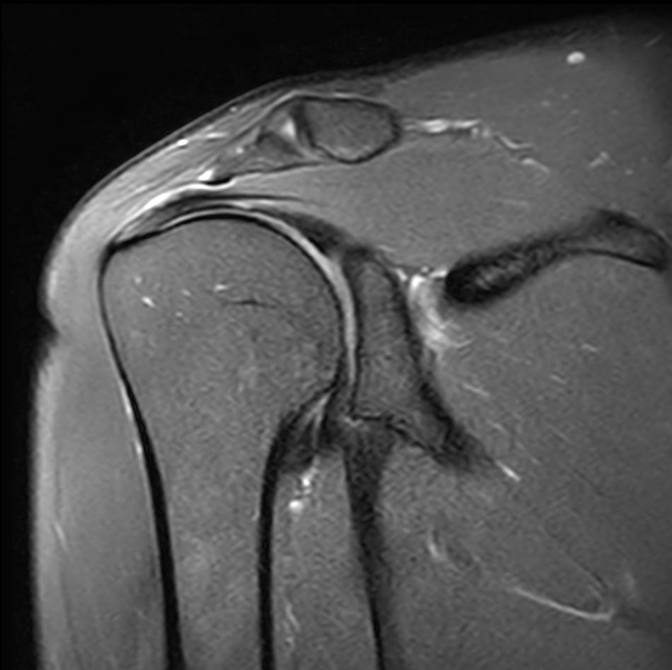 Coronal T2w TSE FatSat