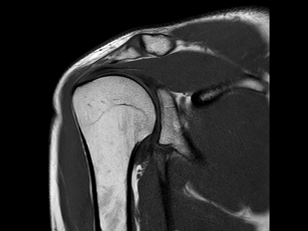 Coronal T1w TSE