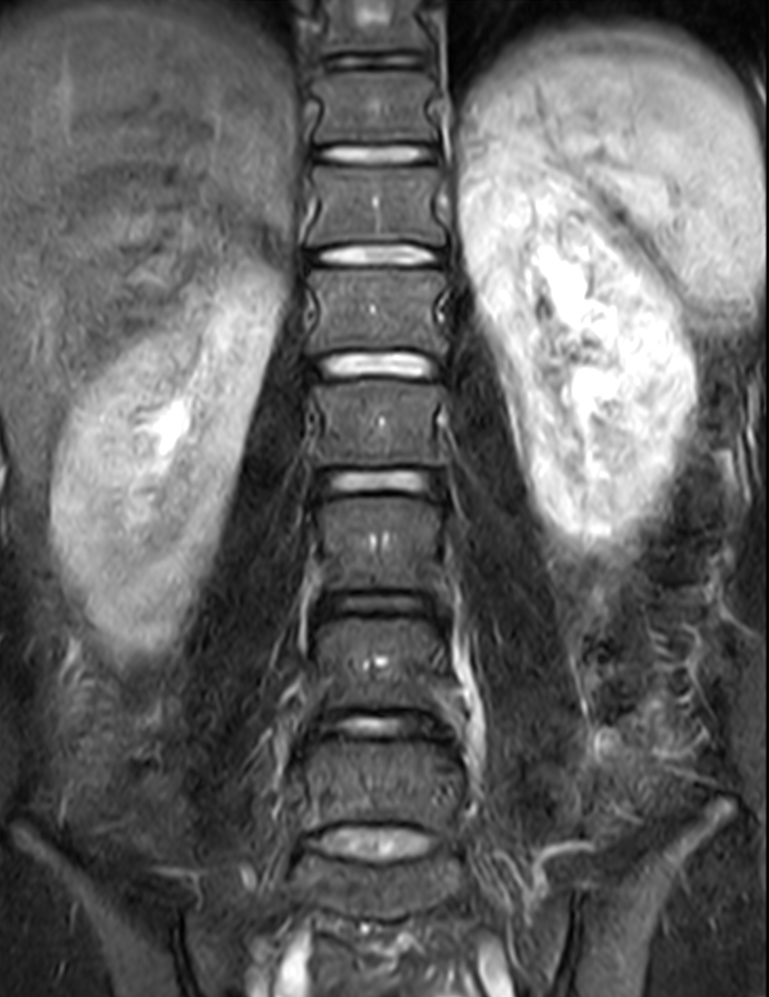 Coronal T2w TSE FatSat
