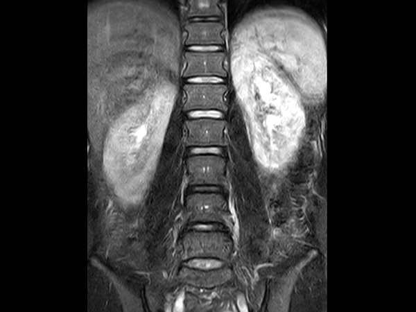 Coronal T2w TSE FatSat