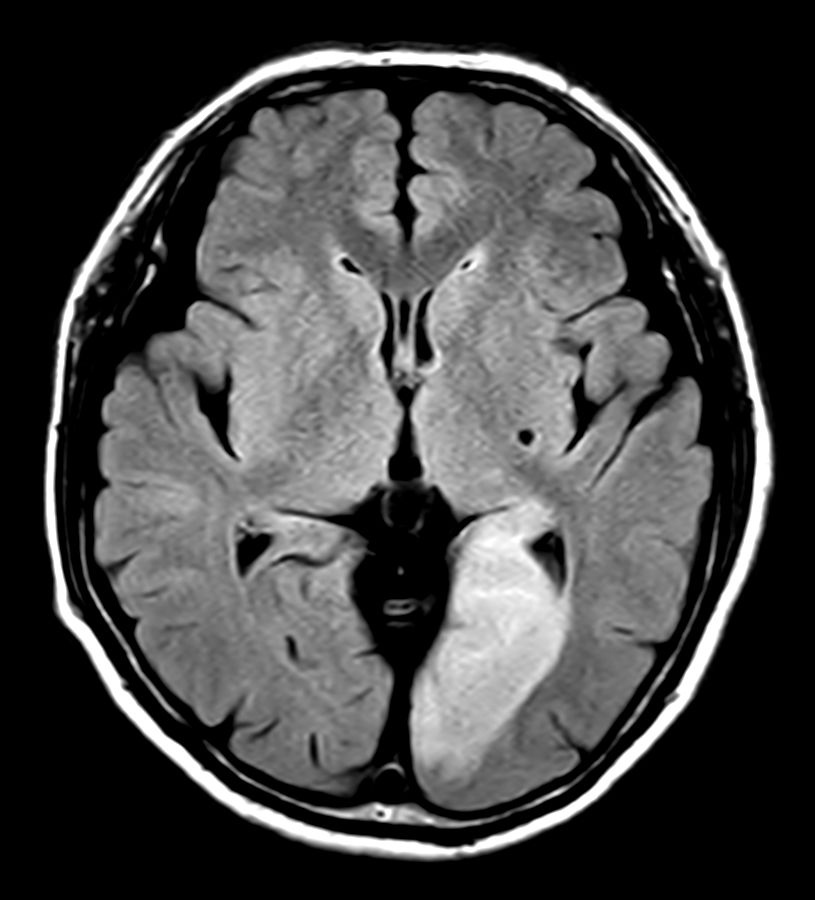 T2w FLAIR - Compressed SENSE