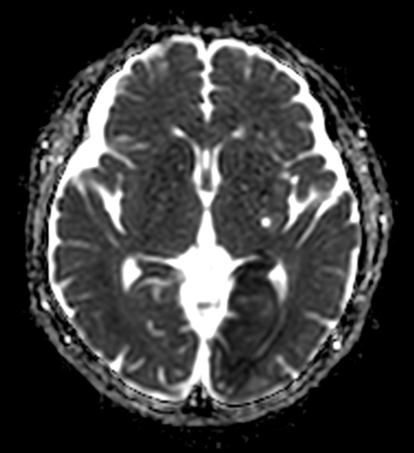 Diffusion - b1000 (ADC)
