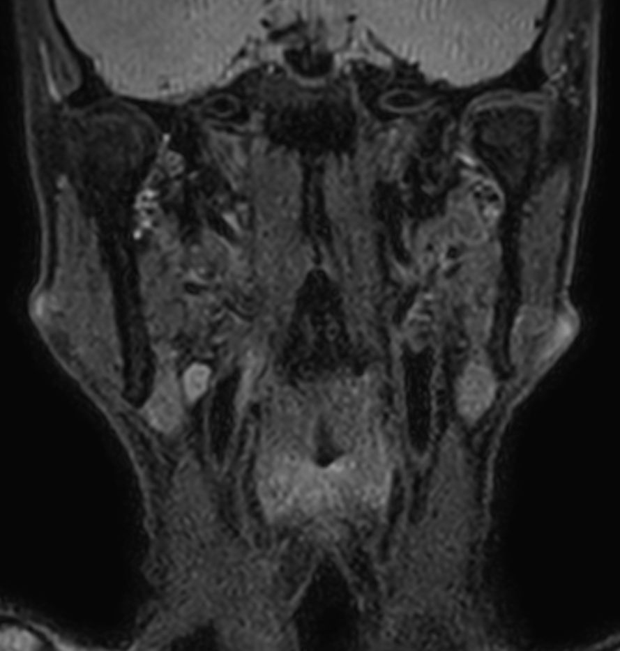 3D T2w TSE Black Blood - Compressed SENSE