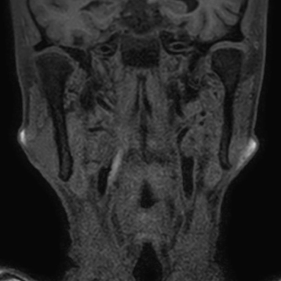 3D T1w TSE Black Blood - Compressed SENSE