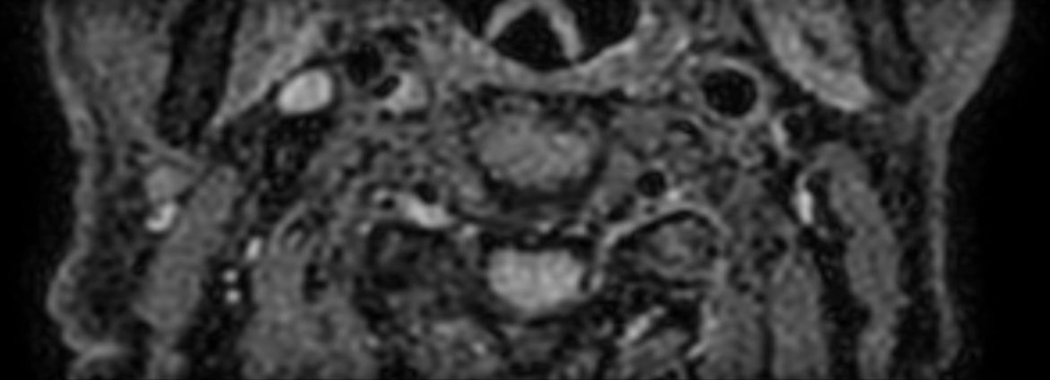 3D T2w TSE Black Blood - Compressed SENSE