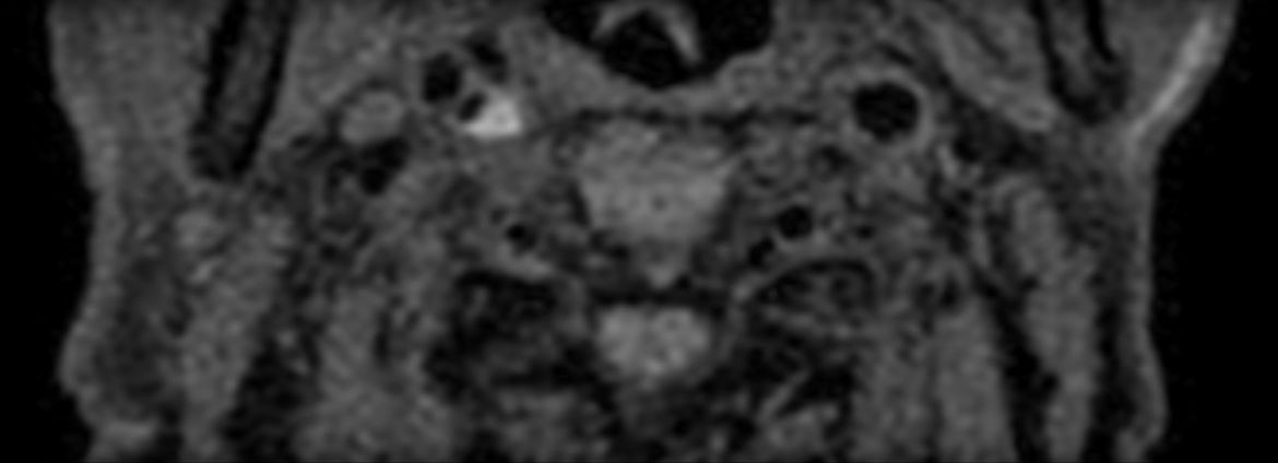 3D T1w TSE Black Blood - Compressed SENSE