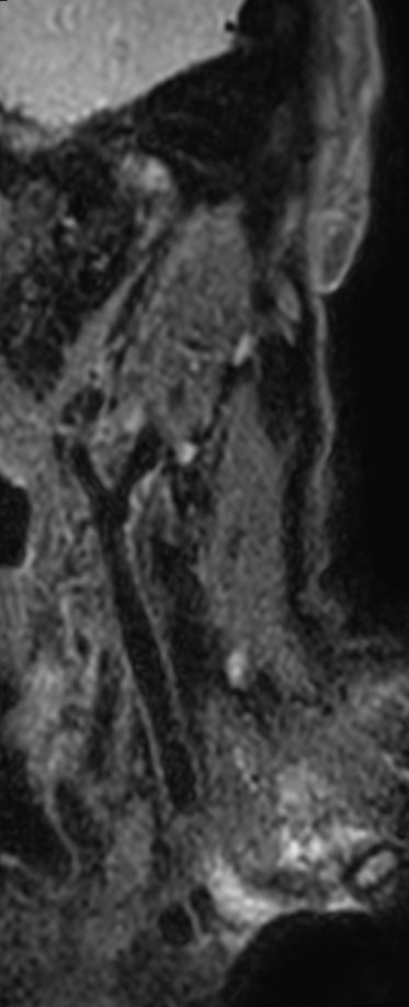 3D T2w TSE Black Blood - Compressed SENSE