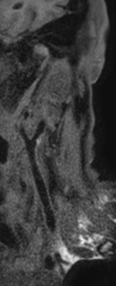 3D T1w TSE Black Blood - Compressed SENSE