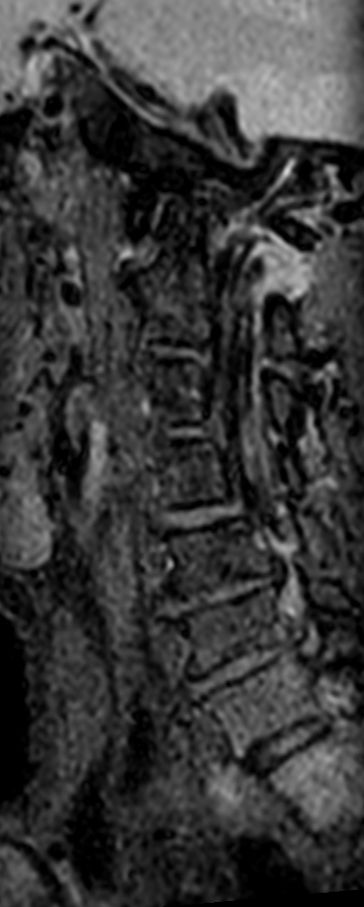 3D T2w TSE Black Blood - Compressed SENSE