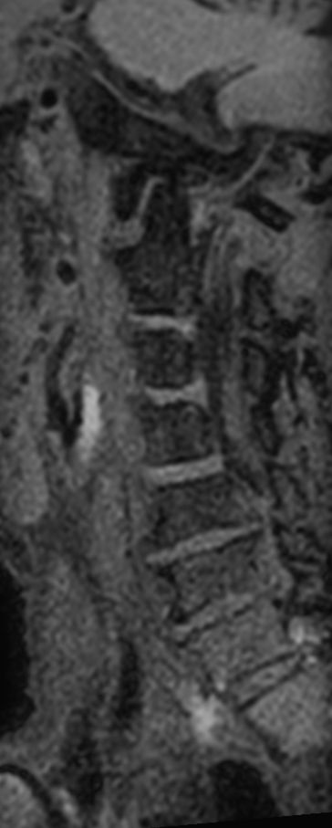 3D T1w TSE Black Blood - Compressed SENSE