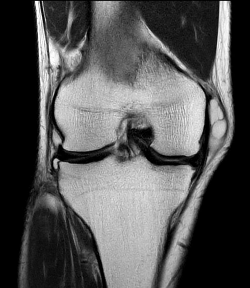 T2w TSE - Compressed SENSE