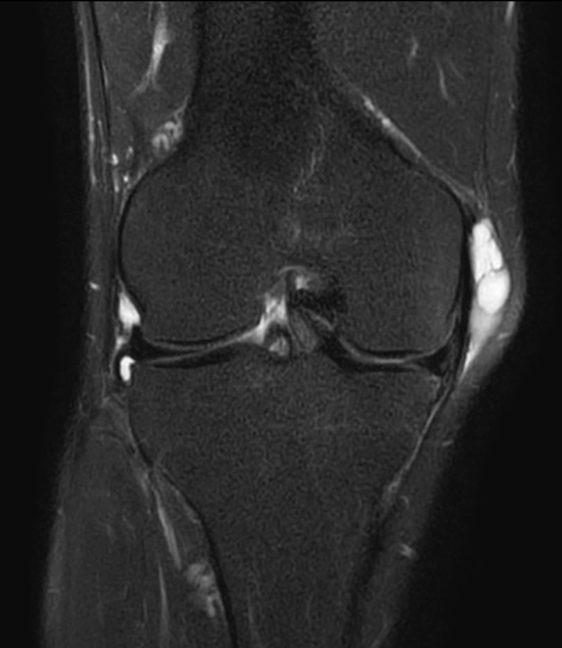 T2w TSE FatSat - Compressed SENSE