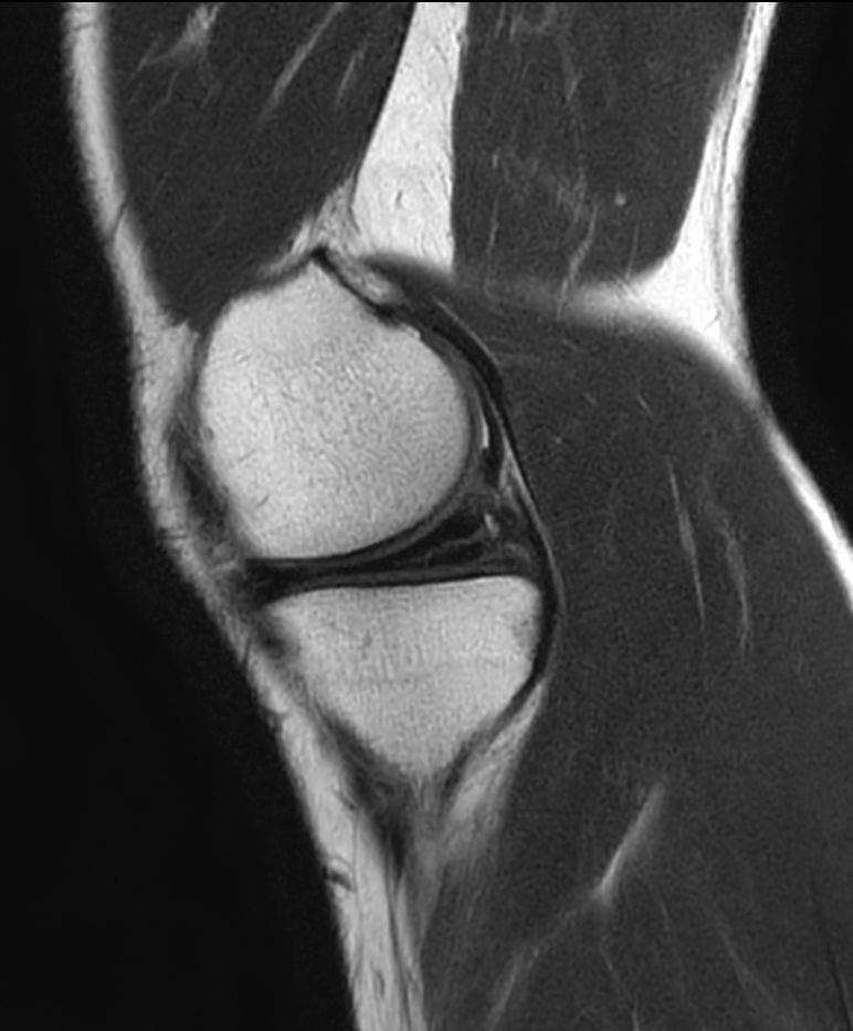 T2w TSE - Compressed SENSE