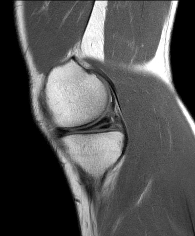 PDw TSE - Compressed SENSE