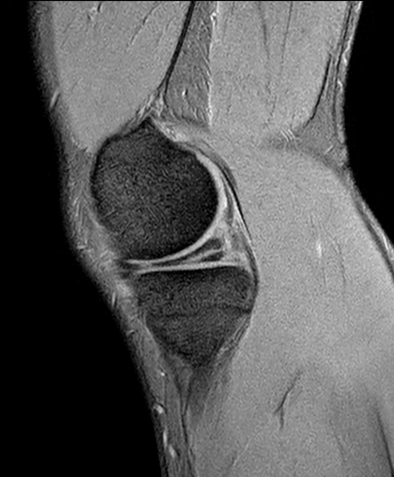 T2w FFE - Compressed SENSE