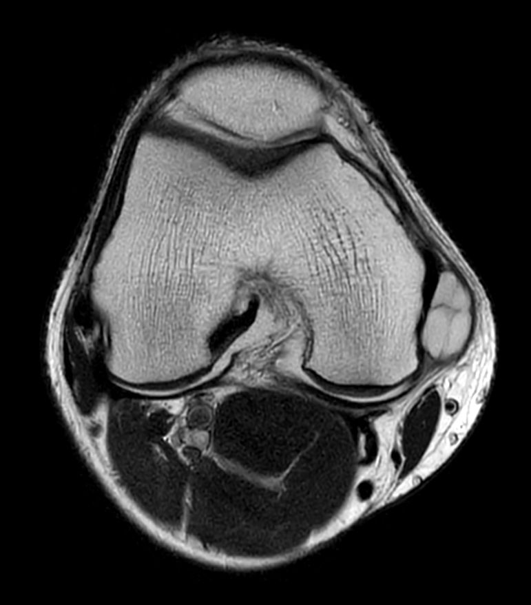 T2w TSE - Compressed SENSE