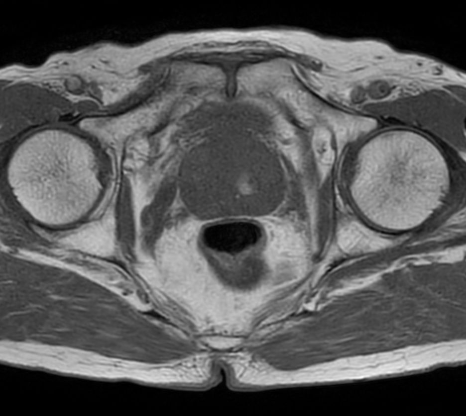 T1w TSE - Compressed SENSE