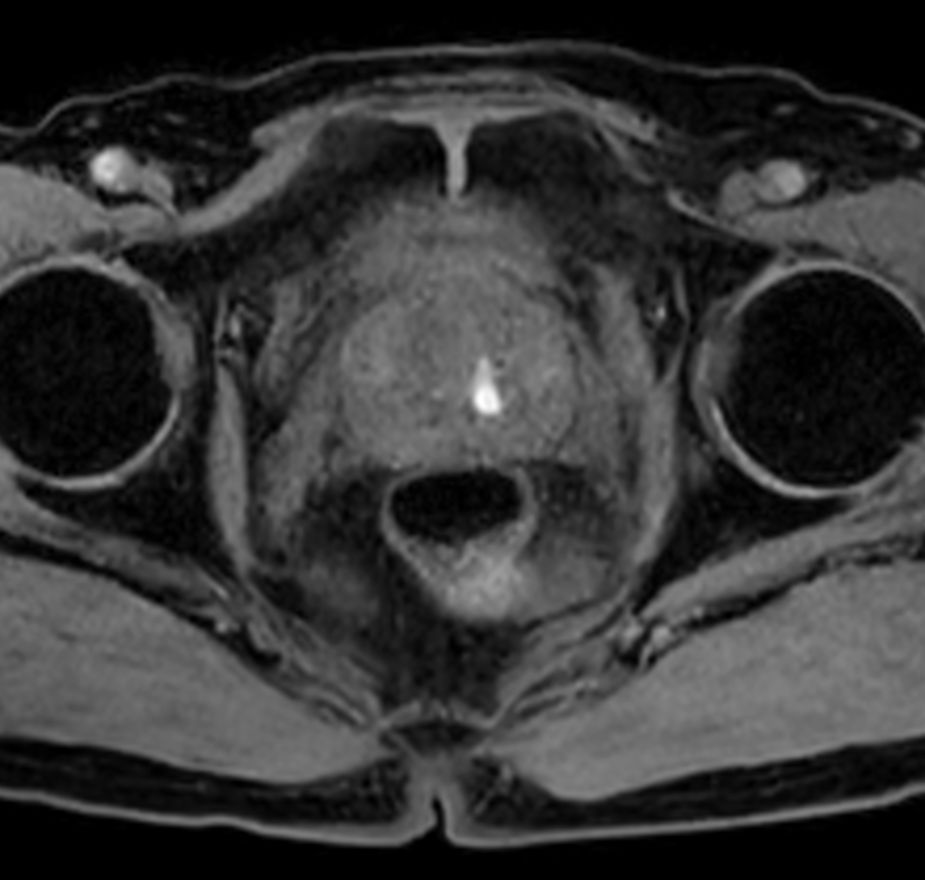 T1w FFE mDIXON XD- Compressed SENSE
