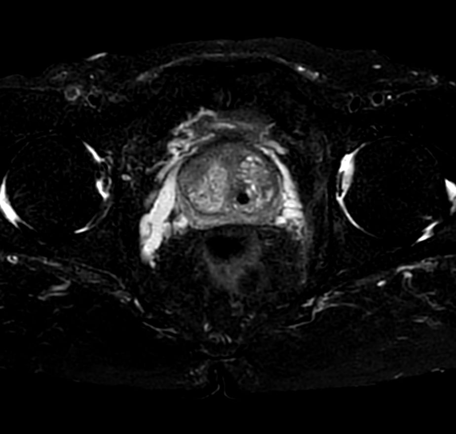 T2w SPAIR - Compressed SENSE