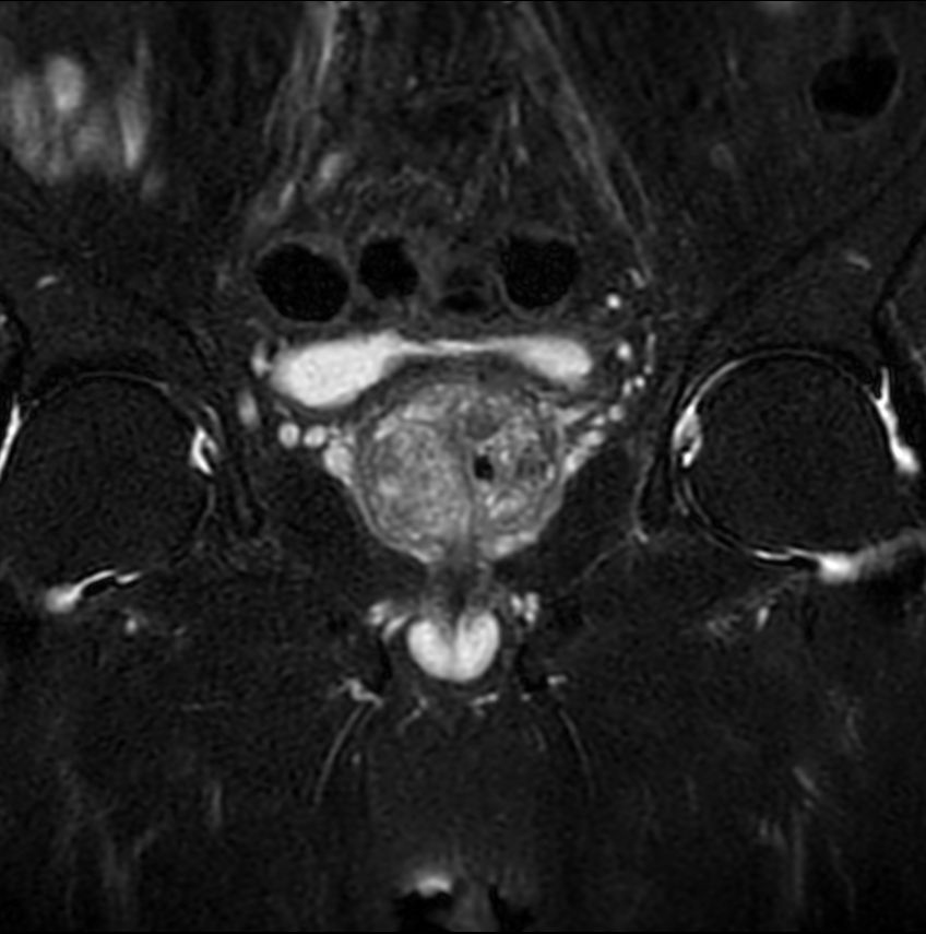 T2w SPAIR - Compressed SENSE
