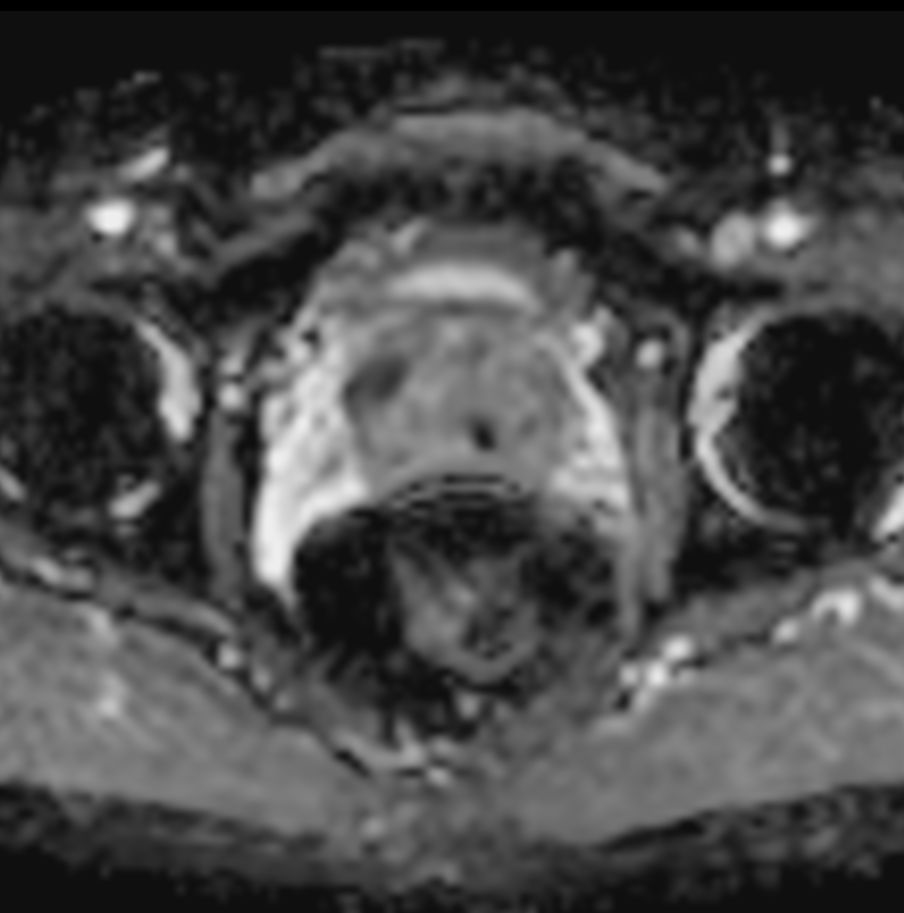 Diffusion - b800 (ADC)