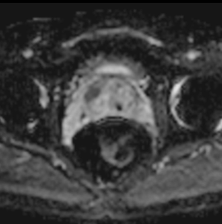 Diffusion - b2000 (ADC)