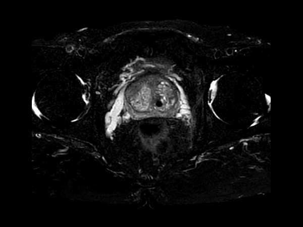 T2w SPAIR - Compressed SENSE