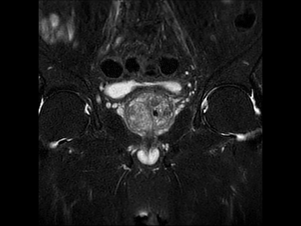 T2w SPAIR - Compressed SENSE