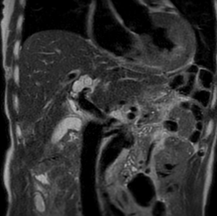 T2w TSE SSh - Respiratory triggering