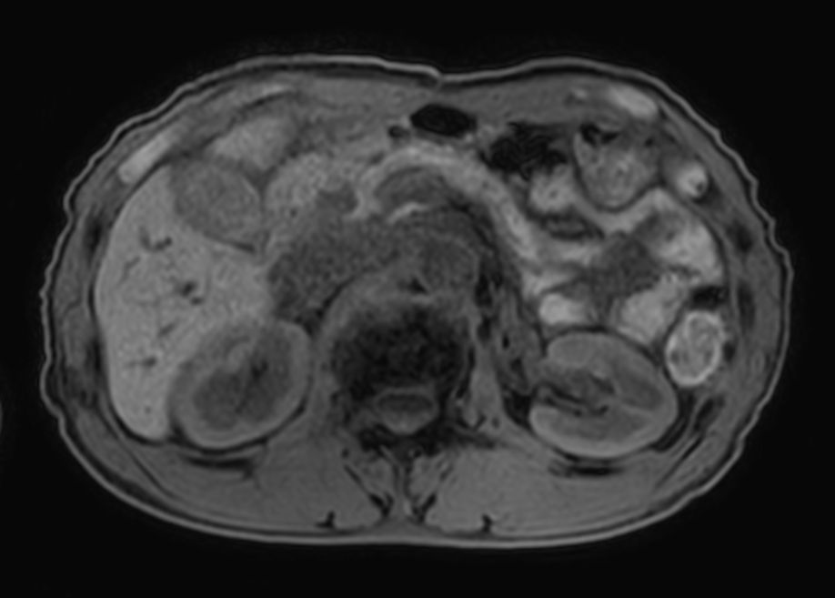 T1w FFE mDIXON XD- Compressed SENSE