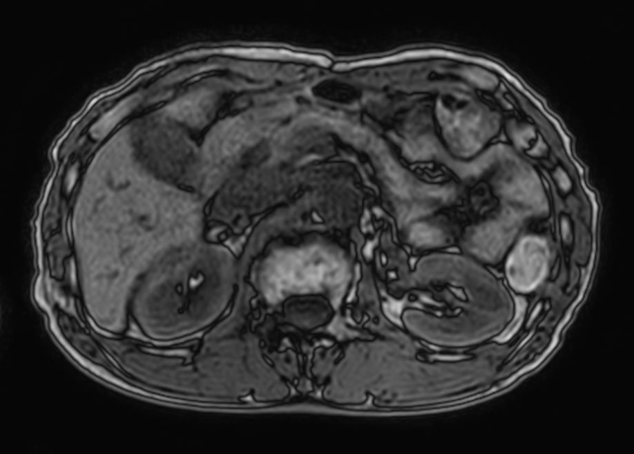 T1w FFE mDIXON XD- Compressed SENSE
