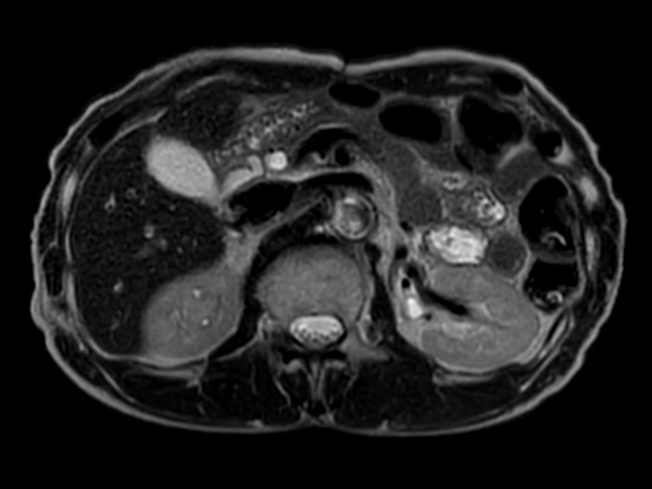 T2w TSE SSh - Respiratory triggering