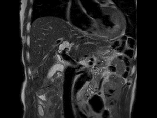 T2w TSE SSh - Respiratory triggering