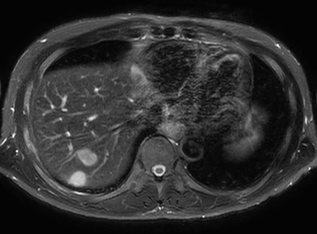 T2w SPAIR - Breath hold