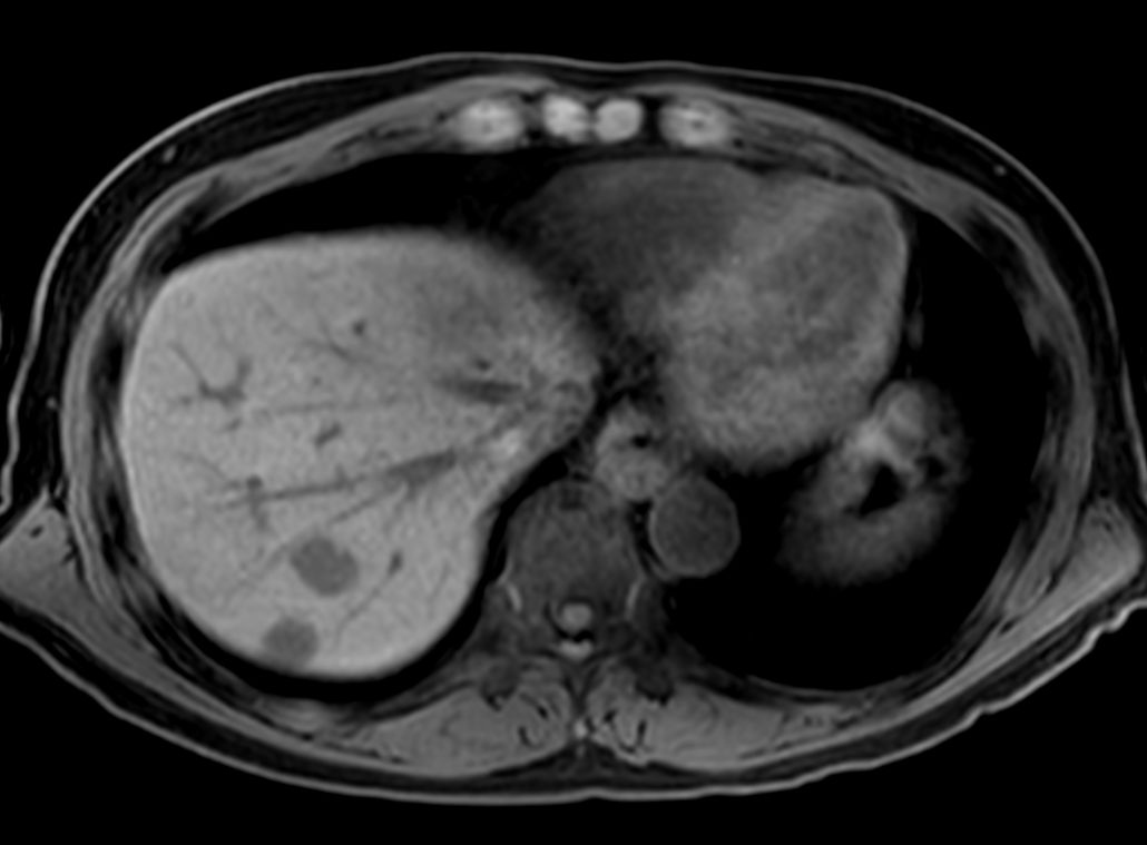 T1w FFE mDIXON XD - Breath hold <b>Compressed SENSE</b>