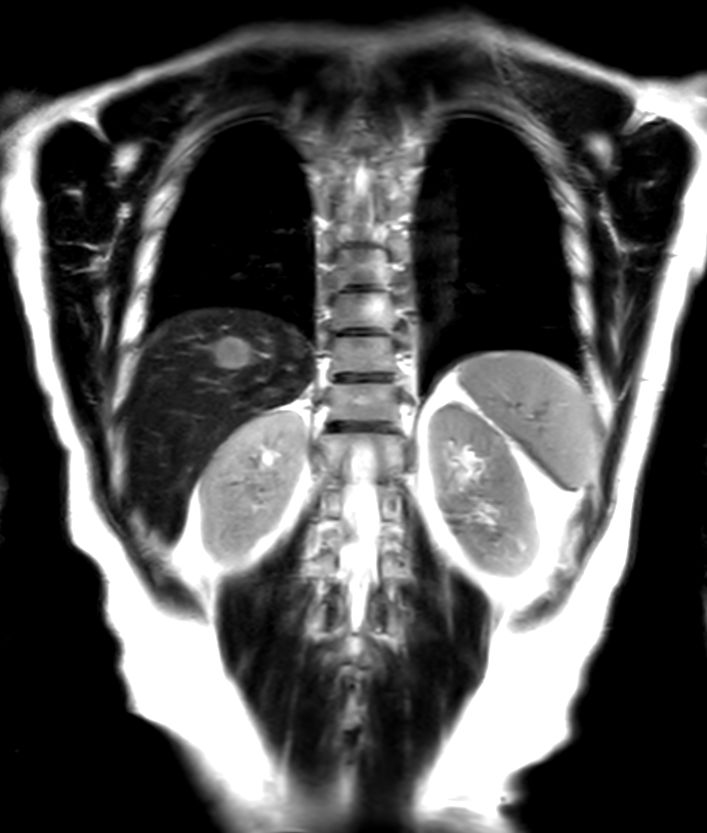 T2w TSE - Breath hold <b>Compressed SENSE</b>