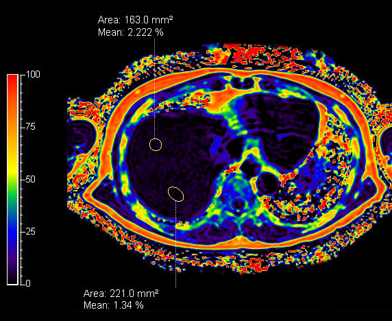 mDIXON Quant (fat percentage) - Breath hold