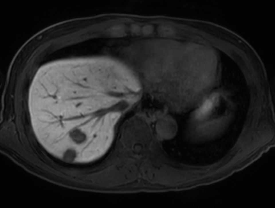 T1w FFE mDIXON XD - Breath hold (15 min. post-gado) <b>Compressed SENSE</b>