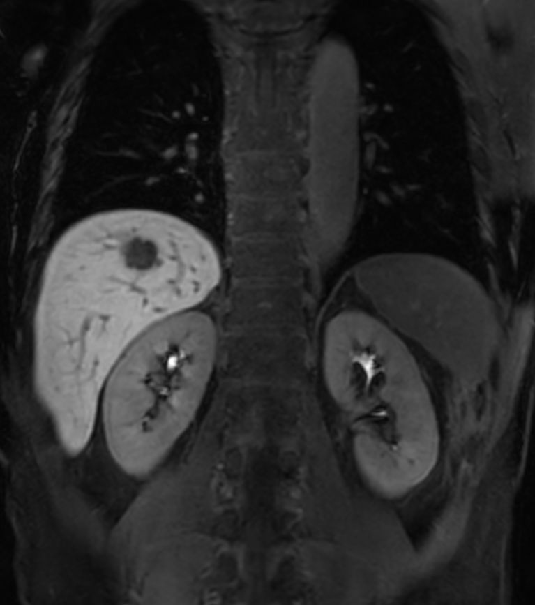 T1w FFE mDIXON XD - Breath hold (15 min. post-gado) <b>Compressed SENSE</b>