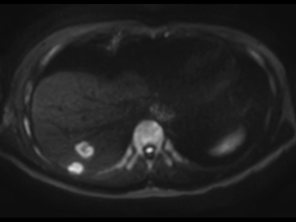 Diffusion b1000 - Free Breathing (VitalEye)