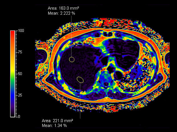 mDIXON Quant (fat percentage) - Breath hold