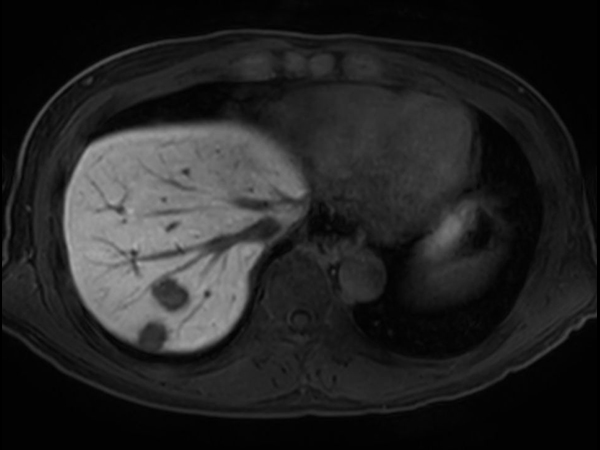 T1w FFE mDIXON XD - Breath hold (15 min. post-gado) <b>Compressed SENSE</b>