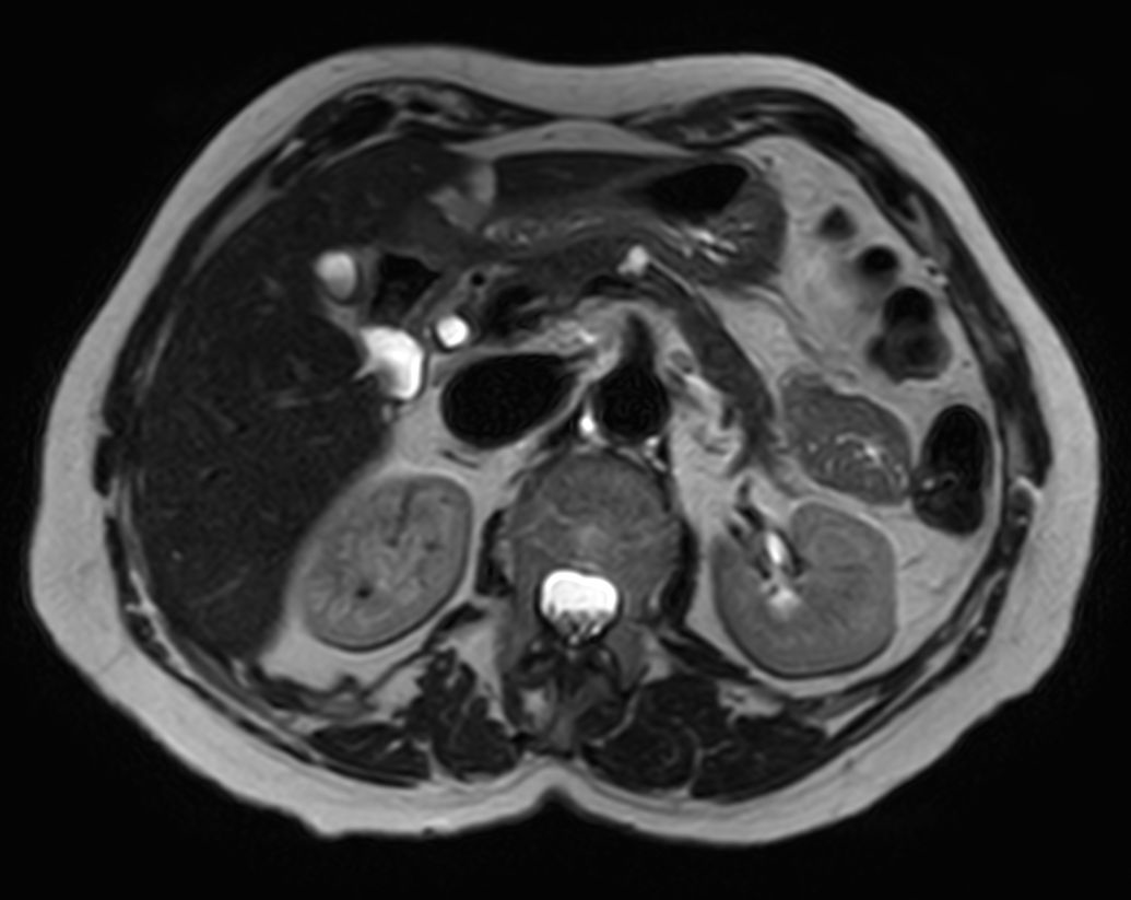 T2w SPAIR - Breath hold