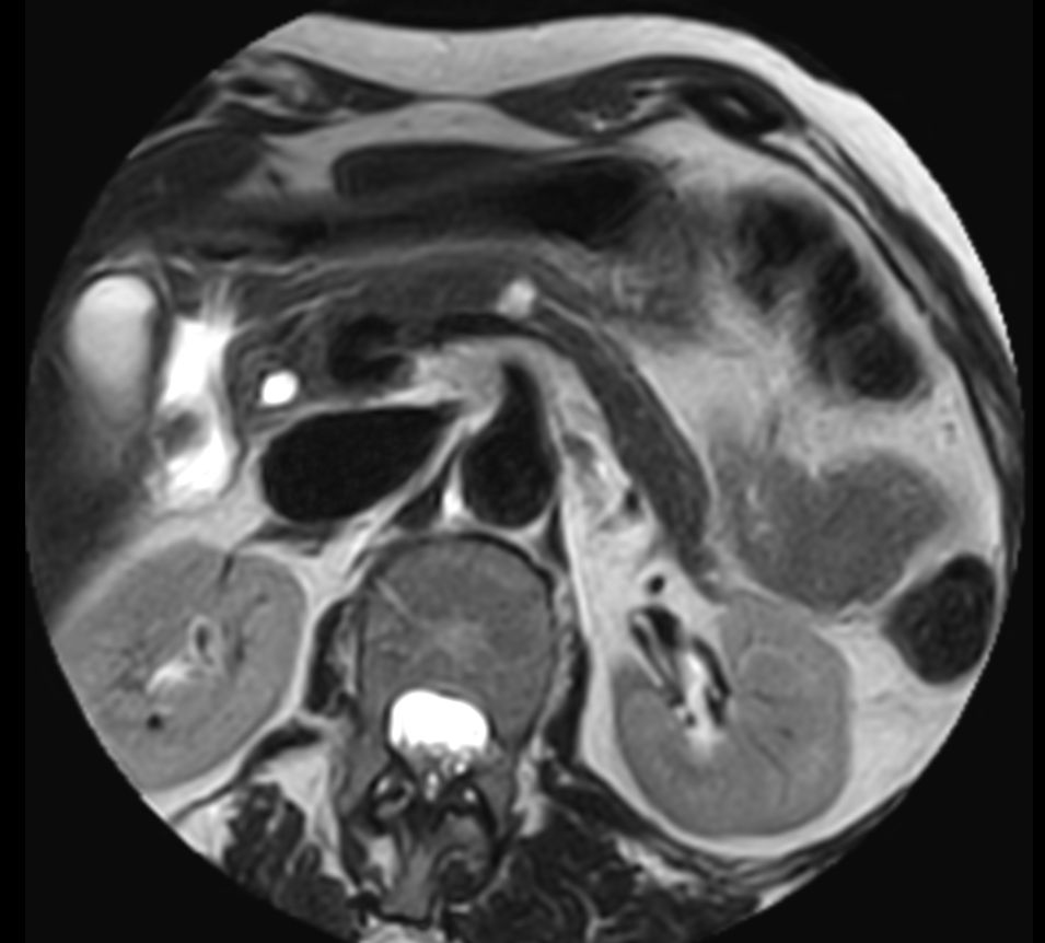 T2w TSE MultiVane XD - Free Breathing (VitalEye)