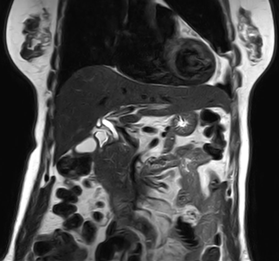 T2w TSE - Breath hold <b>Compressed SENSE</b>