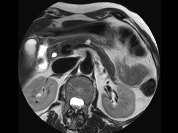 T2w TSE MultiVane XD - Free Breathing (VitalEye)